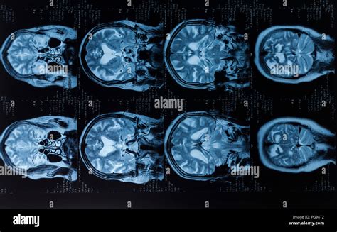 the villages brain mri|Magnetic Resonance Imaging (MRI) .